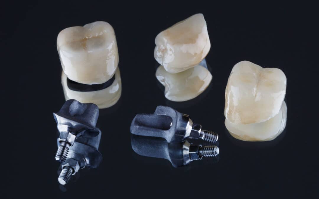 The Complete Guide to Choosing Dental Crowns: Everything to Know