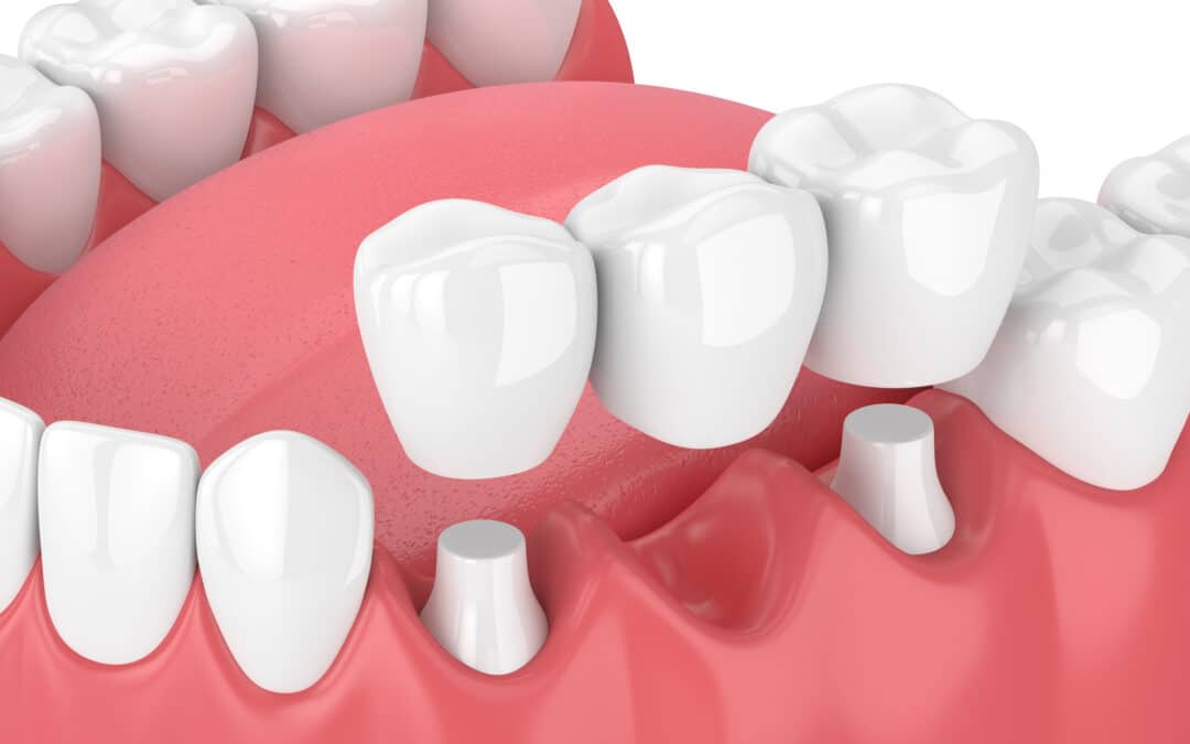benefits of dental crowns